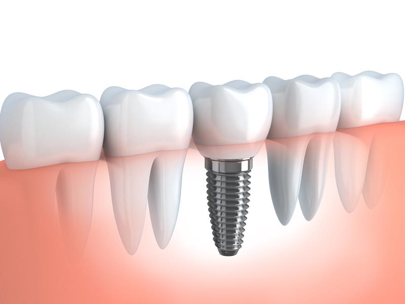 Dental Implants  Carrollton, TX 